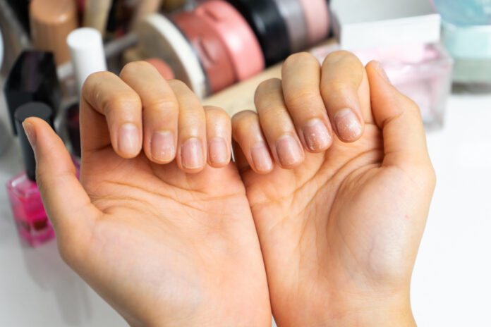 Women,Broken,Nails,From,Gel,Nail,Polish.