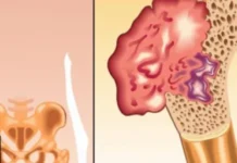 Nedostatak vitamina D može ozbiljno narušiti zdravlje: Obratite pažnju na ove simptome